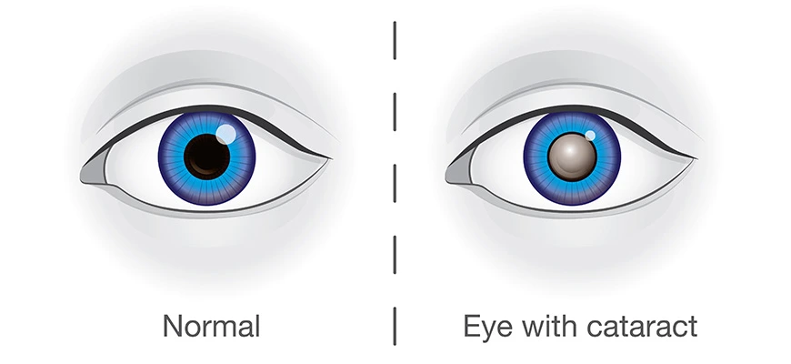 Cataract Surgery in Lucknow