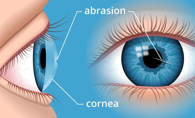 corneal surgeon lucknow