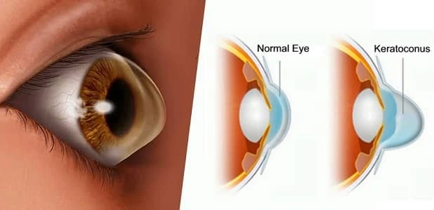 Keratoconus